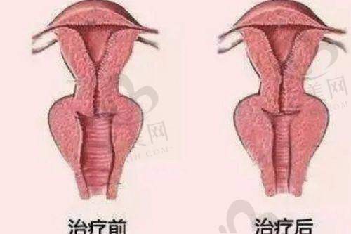 雷虹医生:个性化拉皮的设计骨干医生