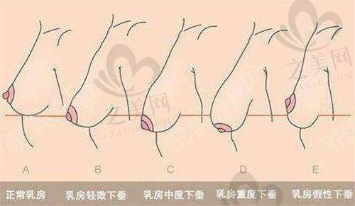 苏州美莱美容医院——胸部整形经验多