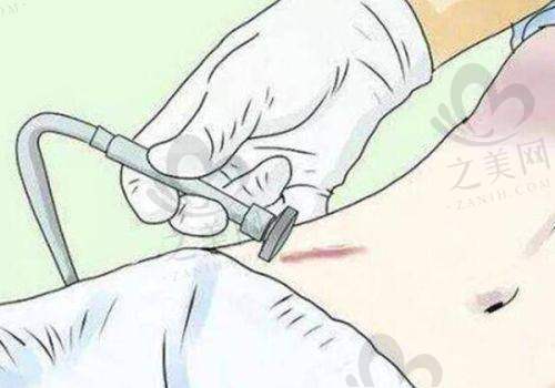 了解手术风险及不推荐情况