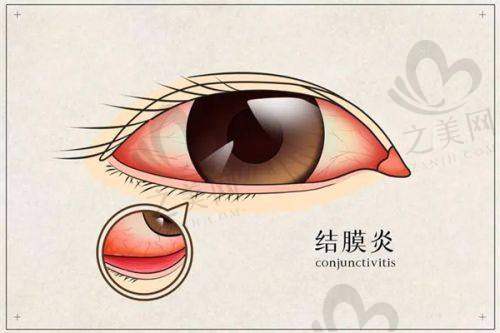 郑州尖峰眼科医院在二七区的近视手术优势