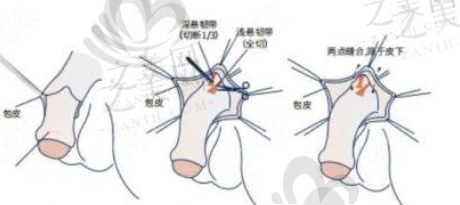 福州男性延长手术优选医院大盘点!福建协和、市一院等多院各具优势!