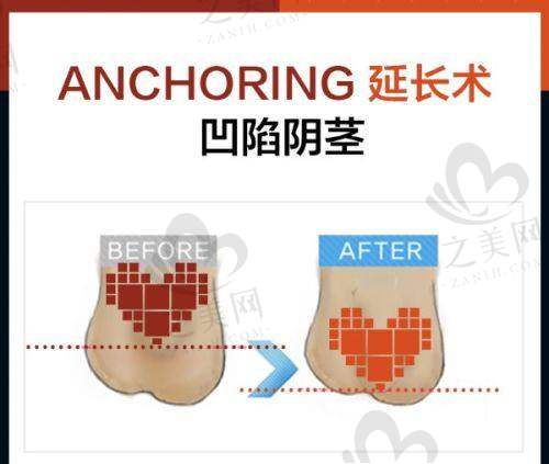 李波医生:小切口拉皮的精细大师