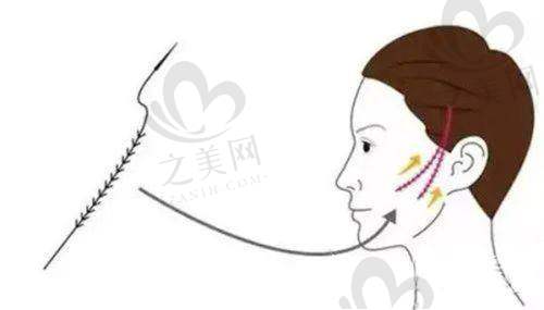 从业多年医生的吸脂把控