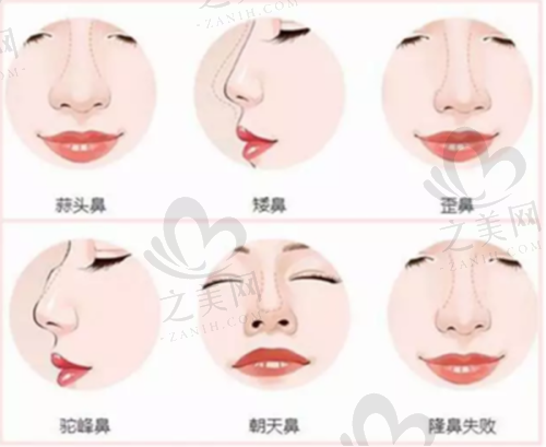 假體隆胸專精醫(yī)生技術不錯