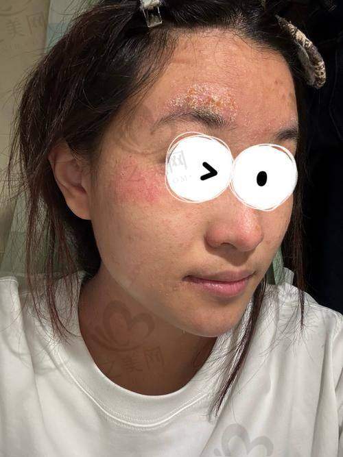 深圳艺星医疗美容医院超皮秒祛痘印