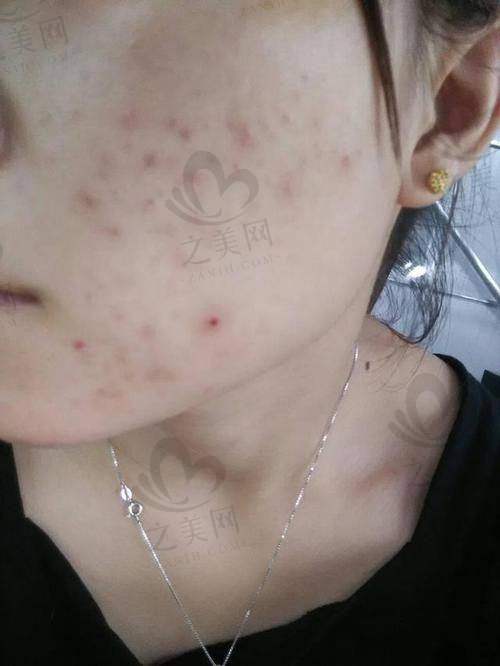 深圳鹏爱整形医院超皮秒祛斑