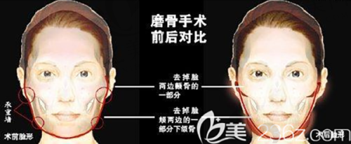 娇兰玻尿酸优势明显