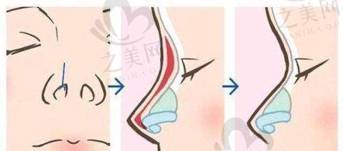 隆鼻项目价格优势明显