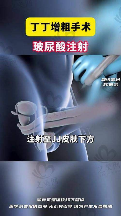 广州建国医院王文卫实例