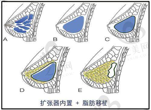 上睑凹陷填充价格优势