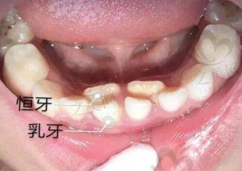 瑞蓝2号玻尿酸维持时间:因人而异