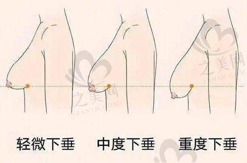 拉皮手术优势显著