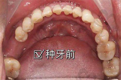 中度深覆合矫正价明确