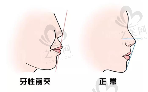 金达威第五代超声聚拉美安心性有保护