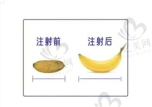 轮廓塑形项目优势