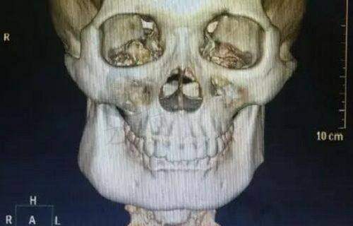 北京增粗手术排名前十医院