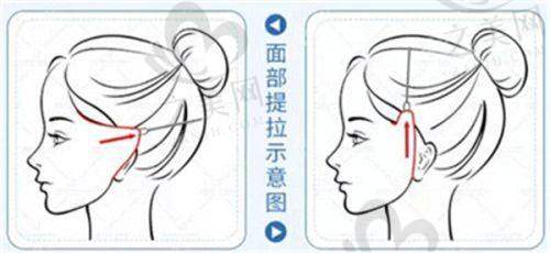 杭州割双眼皮手术价格参考