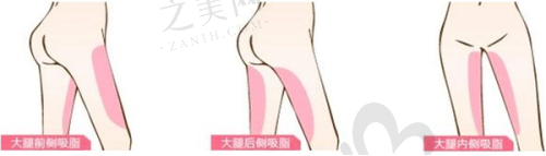 刘立民医生:综合设计修复双眼皮