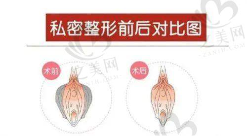 祛斑微针手术的价格情况
