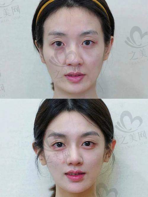 针美汇全脸打3次常见问题解答