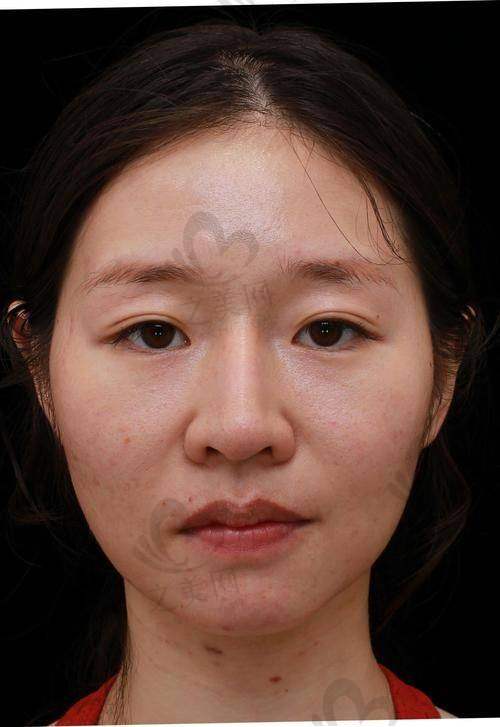 针美汇全脸打3次价格区间