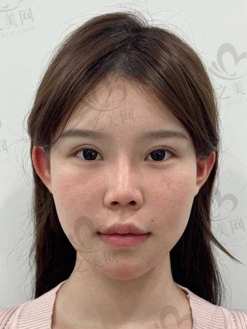 针美汇全脸打3次避坑指南