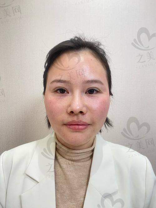 法令纹填充之自体脂肪方案
