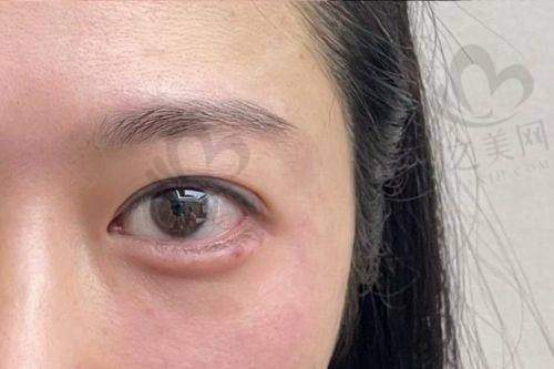法令纹填充的优势