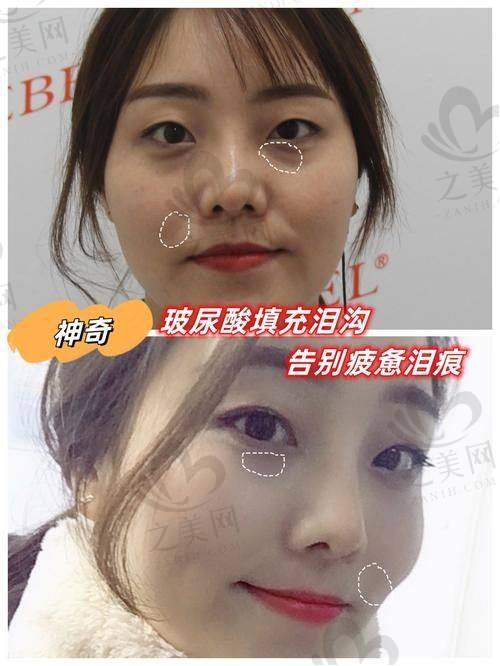 法令纹填充之贝洛芙方案
