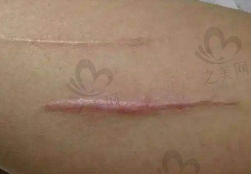 磨骨手术功效突出