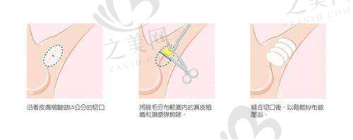 磨骨技术优势显著