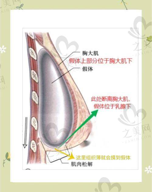 傲诺拉星熠270cc中凸假体：大小合适自然
