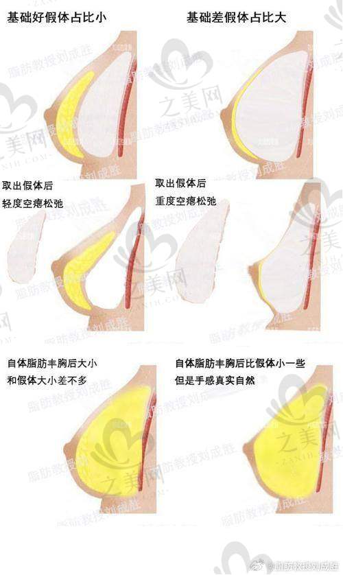 傲诺拉假体优势与价格：满足多样需求