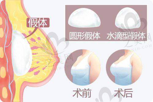 广州黄广香医生：傲诺拉璀璨隆胸成效佳