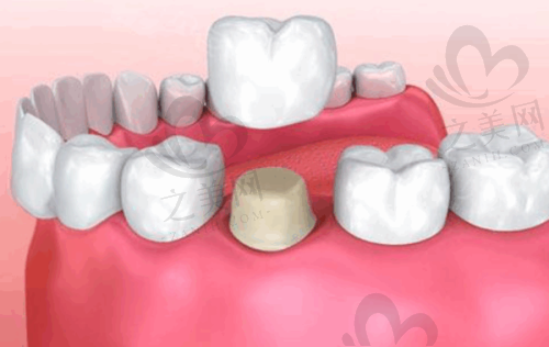 牙龈癌早期症状图片相关特征