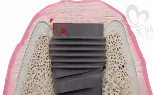 牙龈癌肿块的质地特点