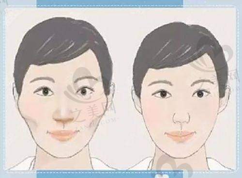 眼袋手术项目