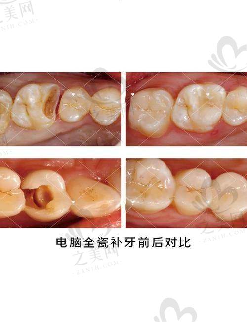老年人半口/全口缺牙的优选方案