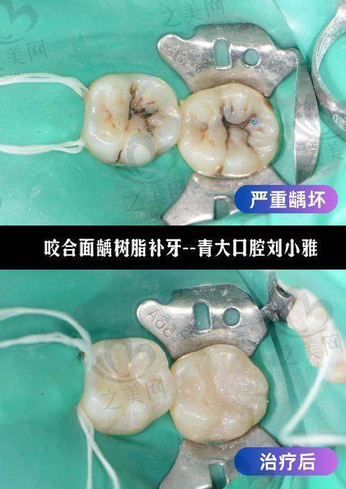 顺义佳美口腔：连锁品牌补牙优选