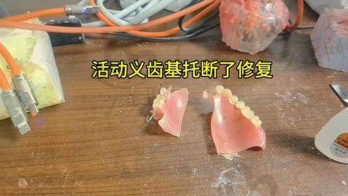 种植义齿：功能强大但价格较高