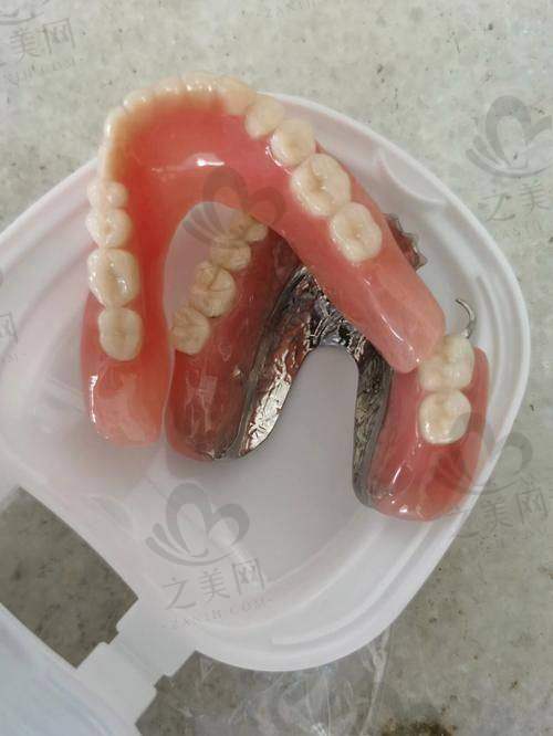 活动假牙：经济适用但有局限