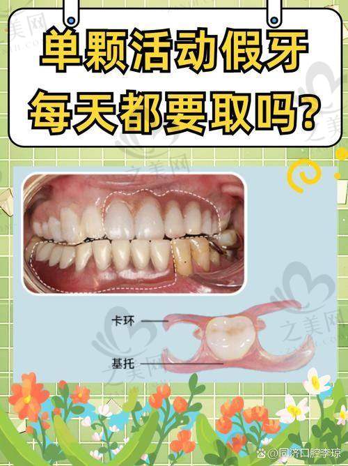 镶牙材料及全口假牙价格参考