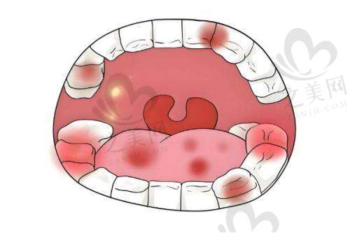 吸附性义齿初期不适