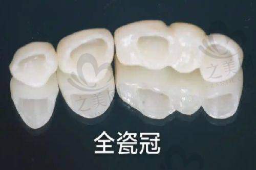 牙齿矫正选择丰富