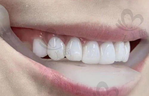 镶牙方式价格多样