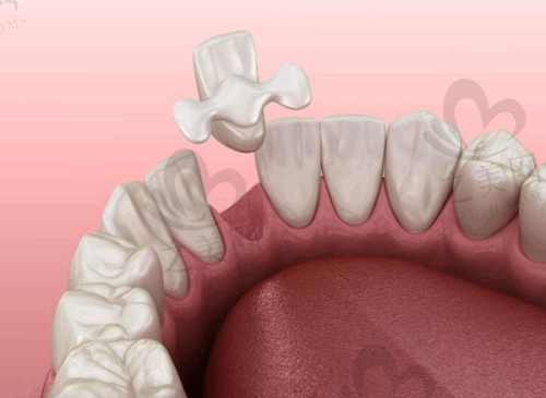 种植牙价格跨度较大
