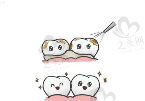 牙齿清洁与消炎价格适中