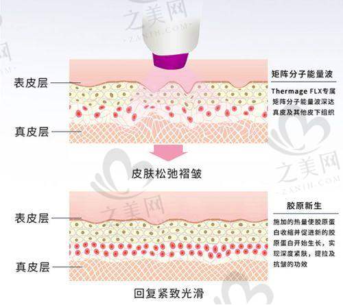 韩国热玛吉全脸价格多少钱一次——与国内价格对比优势