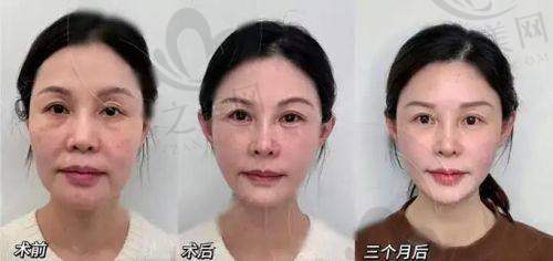 韩国打乔雅登为什么这么便宜呢——供货模式优势