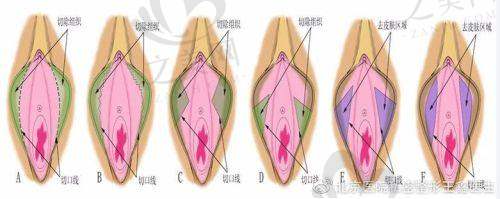 韩国S女性医院不同私密修复项目手术需要多少钱